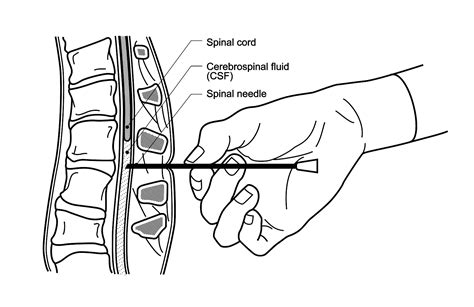 Lumbar Puncture Needle Types