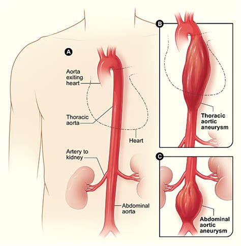 Aortic Aneurysm | NHLBI, NIH