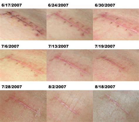 Quotes about Surgery scars (29 quotes)