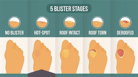 Hot Spot On Foot: The 2nd Stage In The 5-Stage Blister Process [Theory] - YouTube