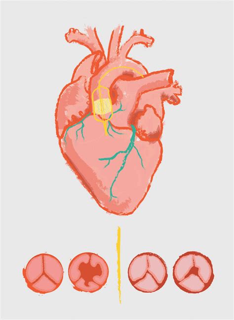 open heart surgery clip art 10 free Cliparts | Download images on ...