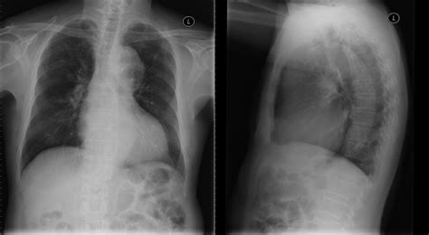 The Thoracic Aorta | Radiology Key