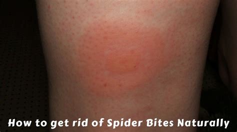 Can You Always Feel A Spider Bite / How to treat a spider bite and when ...