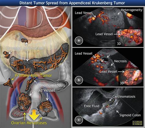 Ovarian Tumors (Clinical Setting and US) | Radiology Key