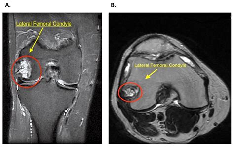 Fémur Condyle Latéral