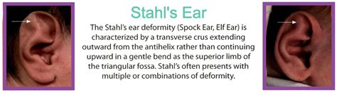 Stahl’s Ear Correction | NYC and Trumbull, CT | Ears R Us