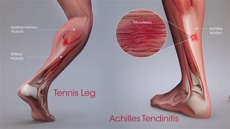 Achilles Tendonitis Pain: Causes, Symptoms, And | atelier-yuwa.ciao.jp