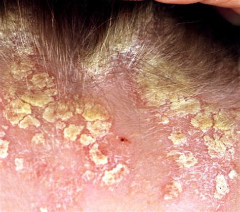 Scalp Psoriasis - Causes, Symptoms, Treatment, Pictures, Remedies ...