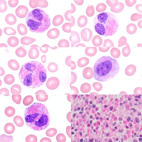 Eosinophilic Myelocyte