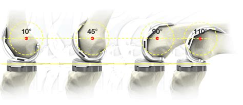 Total Knee Replacement | Stryker | Stryker