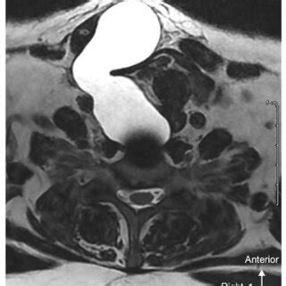 axial T2-weighted MRI showing anterior meningocele with left-displaced ...