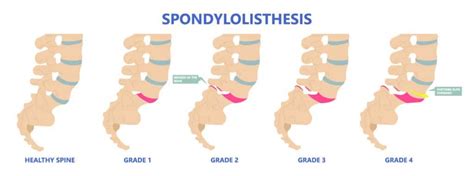 Retrolisthesis: Definition - Spine Info