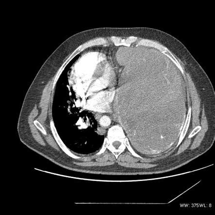 Solitary fibrous tumor | Radiology Reference Article | Radiopaedia.org