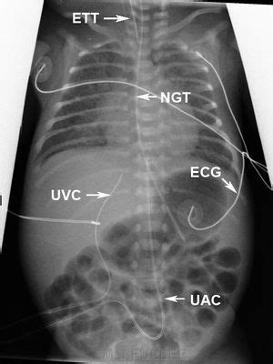 Umbilical vein catheterization - WikEM