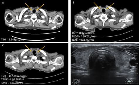 Progressive loss of the thyroid tissue integrity visualised by serial CT scans | BMJ Case Reports