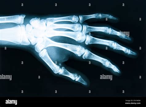 X ray skeleton hi-res stock photography and images - Alamy