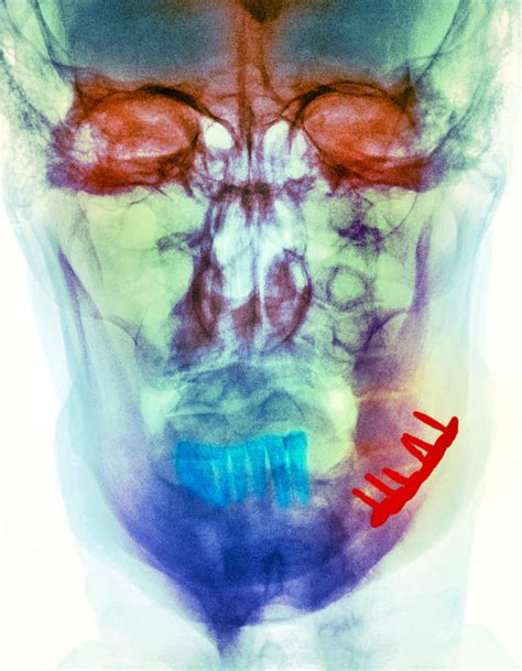 Pinned Broken Jaw, X-ray Photograph by - Fine Art America