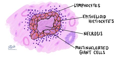 Necrotizing granulomatous inflammation | MyPathologyReport.ca