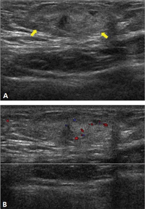 Sebaceous Cyst Vs Lipoma Ultrasound | Sitelip.org