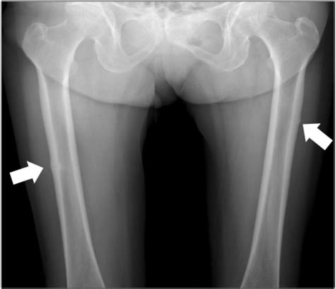 Plain radiograph of both femurs. Linear fracture line w | Open-i