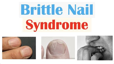 Brittle Nail Syndrome Causes, Signs & Symptoms, Diagnosis, brittle nails