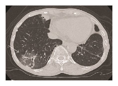 Findings on chest radiography and computed tomography. (a) Chest... | Download Scientific Diagram