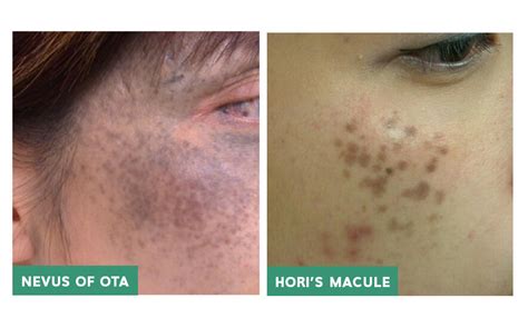 Hori's Macule, Birthmark Removal in Singapore | Dr Wong Soon Tee