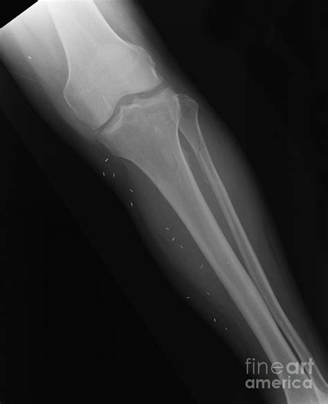 X-ray Of Broken Leg Photograph by Ted Kinsman - Fine Art America