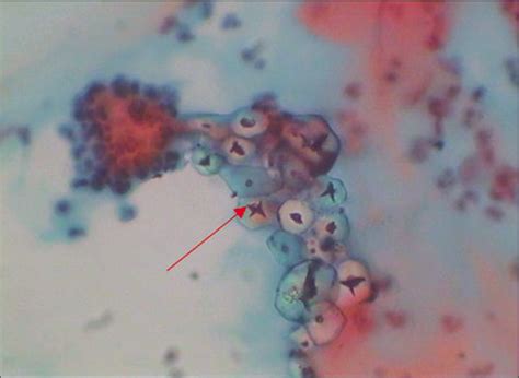 Pap Smear Collection and Preparation: Key Points - CytoJournal