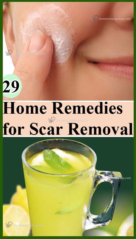 29 Home Remedies for Scar Removal | Home remedies for acne, Scar removal, Natural wart remedies