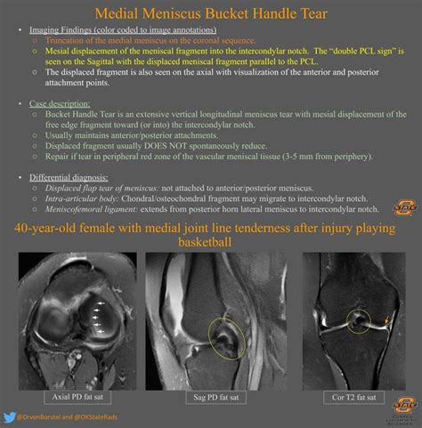 Medial Meniscus Bucket Handle Tear - MSK Radiology Imaging ...