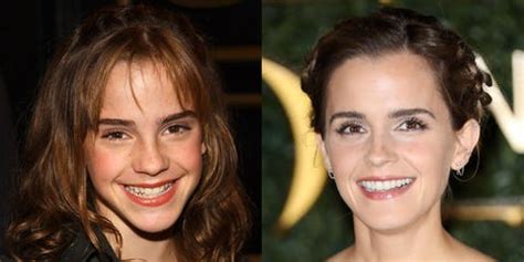 10 Celebrities with Veneers - Celebrities Who Had Major Teeth Transformations