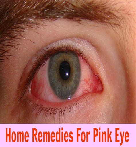 Home Remedies For Pink Eye | Tips Park