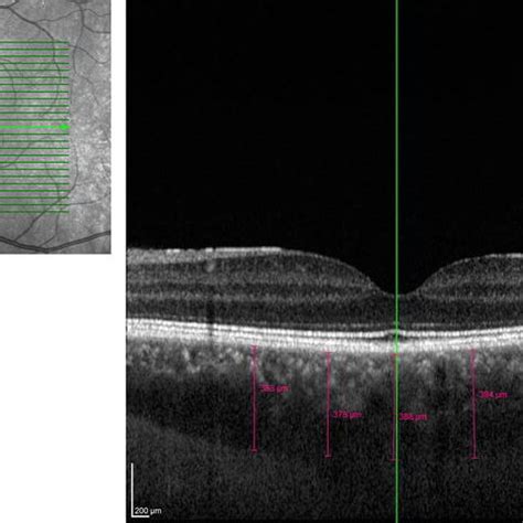 Mean choroidal thickness measurements; subfoveal choroidal thickness ...