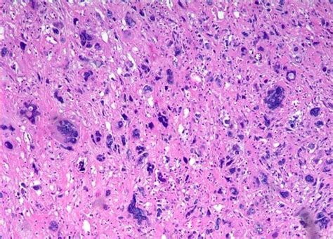 Soft Tissue Sarcoma - Pathology - Orthobullets