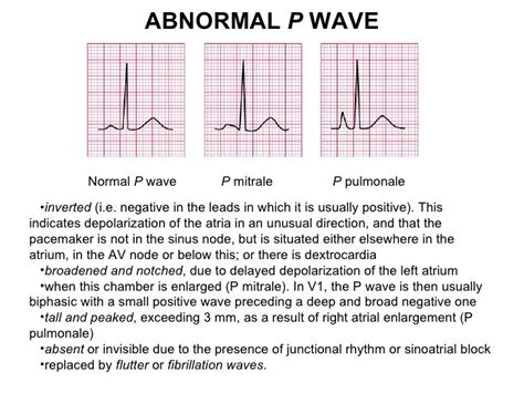 Ecg lecture