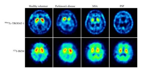 Dopamine Brain Scan