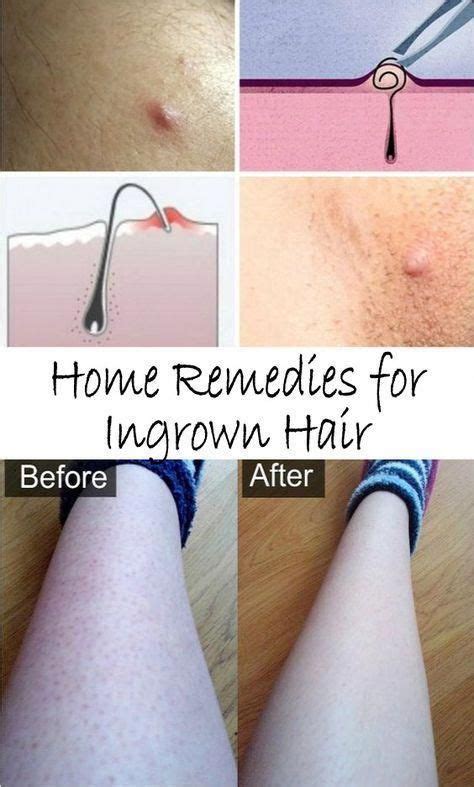 Ingrown hair is generally known as razor bumps that have the strength to grow back into the ...