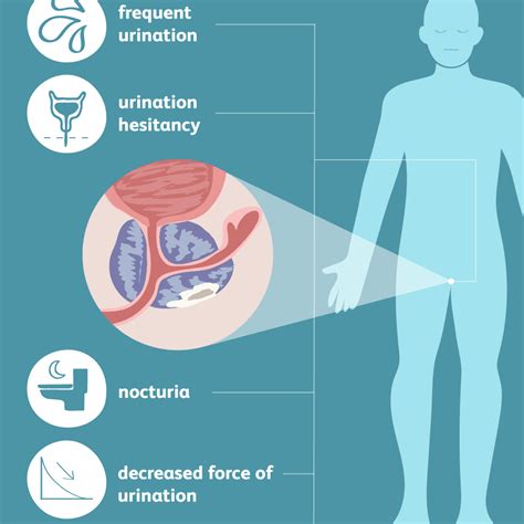 How To Relieve Prostate Pain - Englishsalt2