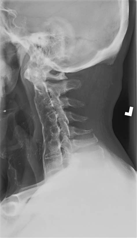 Post-infectious ankylosis of the cervical spine in an army veteran: a case report | Chiropractic ...