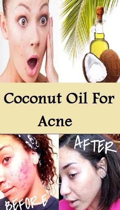 Coconut Oil For Acne | Coconut oil for acne, Body acne treatment