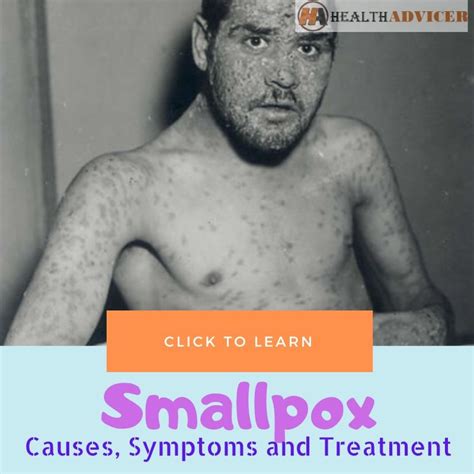 Smallpox Disease