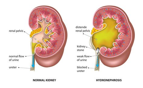 Ureteropelvic Junction Obstruction: Symptoms, Cause, Diagnosis, and Treatment