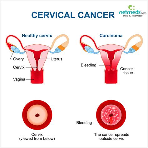 Cervical Cancer: Causes, Symptoms And Treatment | Netmeds