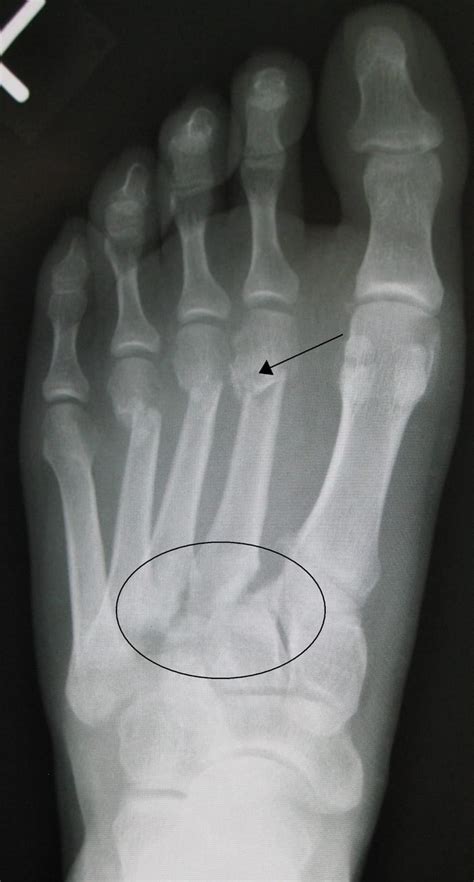 Lisfranc fracture | Symptoms | Causes | Treatment - DFW Foot and Ankle Care - Dr. Zubeen Mistry