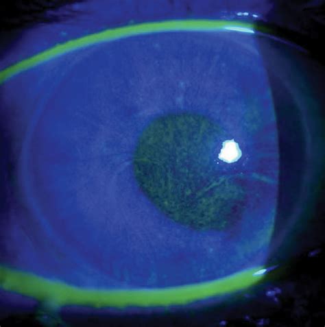 Fine-Tune Your Corneal Disease Diagnostic Skills