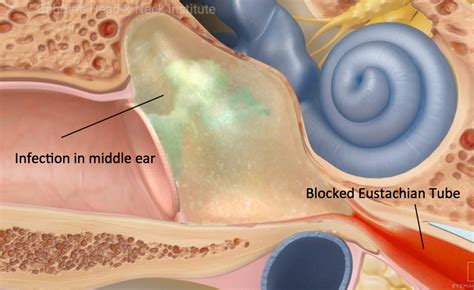 Ear Infections Treatment Los Angeles, CA