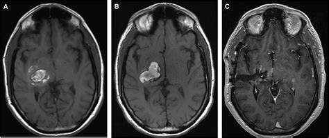 Cavernous Malformation of Brainstem, Thalamus, and Basal Ganglia: A ...