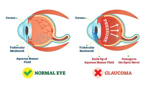 Glaucoma Treatment - Henderson Eye Care | Springfield, MA