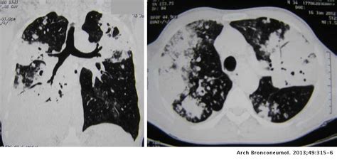 Carcinoma broncoalveolar en un paciente joven: caso clínico | Archivos de Bronconeumología